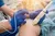 Radiofrequency Ablation
