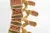 Osteoporosis