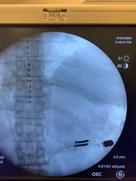 Dr. Rosenfeld Provides First Nalu Implant In Georgia
