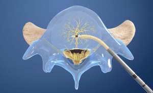 Diagram of the Relievant Intracept procedure