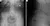 Alliance Performs First Interspinous Fixation Device In The State